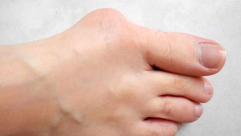 anormală piciorului, degetului mare, articulația picioarelor, afectează degetele, afectează degetele picioare