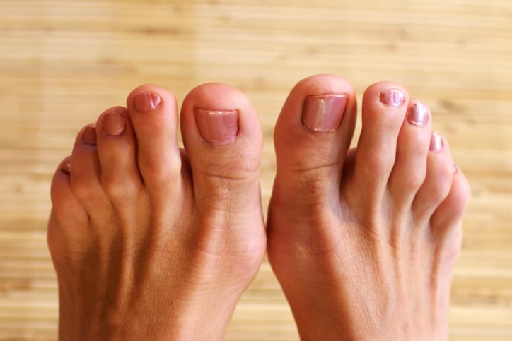 anormală piciorului, degetului mare, articulația picioarelor, afectează degetele, afectează degetele picioare