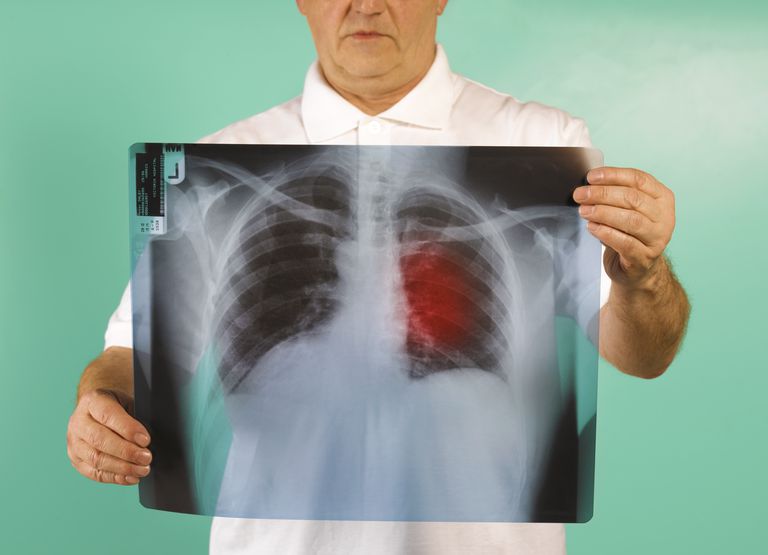 cancer pulmonar, cancerului pulmonar, pulmonar stadiul, cancer pulmonar stadiul
