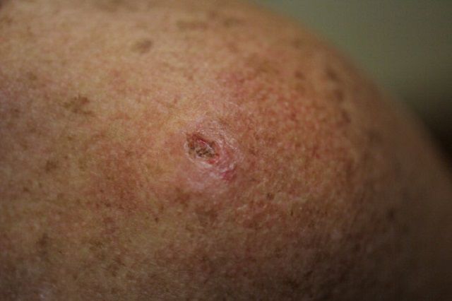 cancer piele, cancerul piele, piele este, asiatici Latine, cancer piele non-melanom