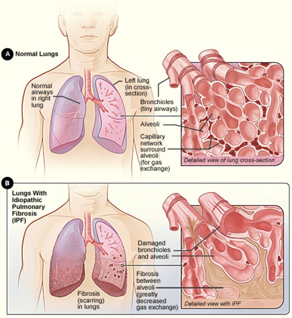 această boală, fibrozei pulmonare, pulmonară idiopatică, Statele Unite, care trăiesc, care trăiesc boala