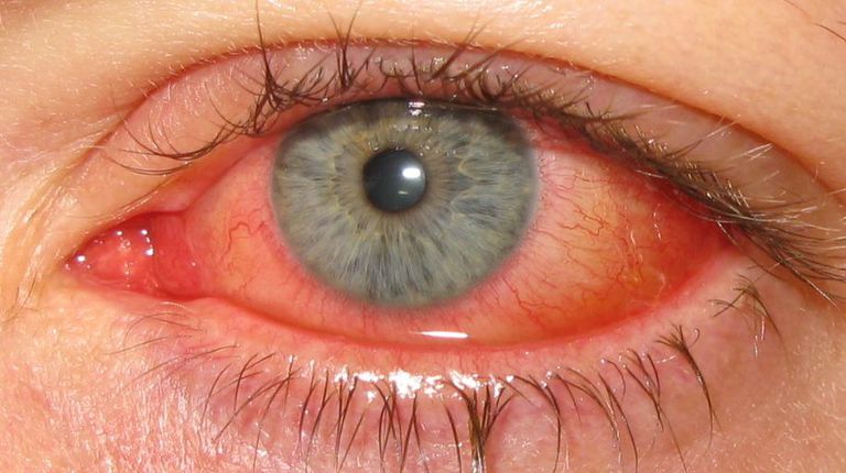 conjunctivitei atopice, dermatită atopică, interioară pleoapelor, oftalmolog optometrist, simptomele sunt