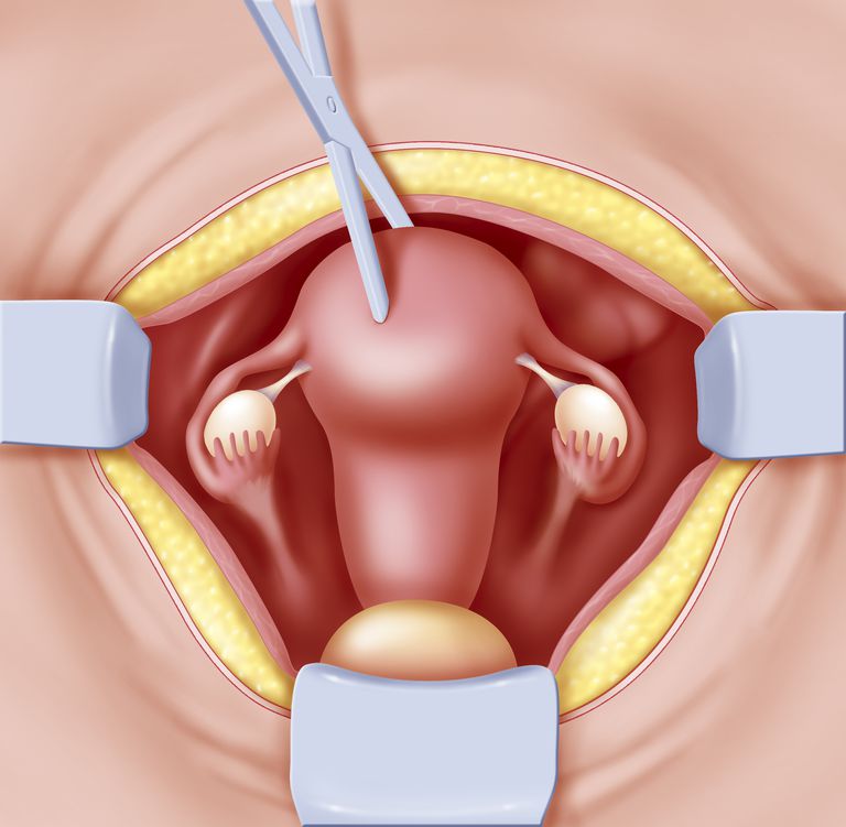 intervenție chirurgicală, după histerectomie, histerectomie este, intervenția chirurgicală