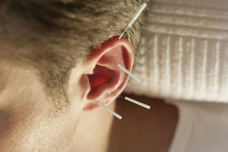 acupunctura urechii, acupuncturii urechii, studiu publicat, urechii poate, acupunctura urechii poate