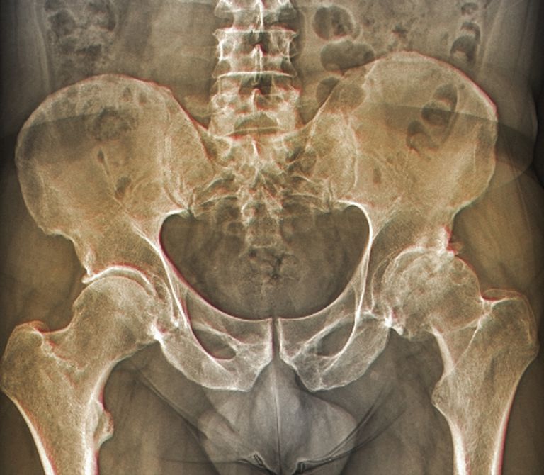 capetele osului, boală cartilajului, capetele oaselor, dacă există, Radiografiile arăta