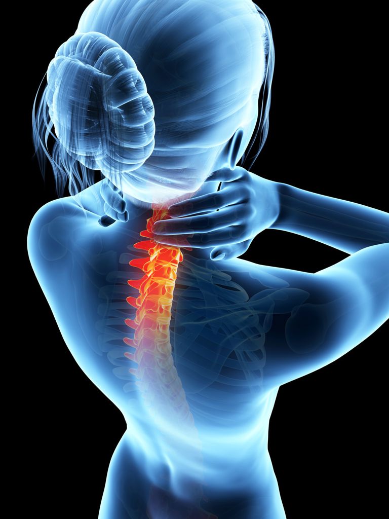 coloanei vertebrale, măduvei spinării, coloana vertebrală, artrita reumatoidă, asupra măduvei