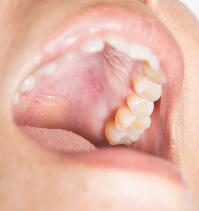 nivelul gurii, Caphosol pentru, timpul chimioterapiei, Caphosol Caphosol, Caphosol este