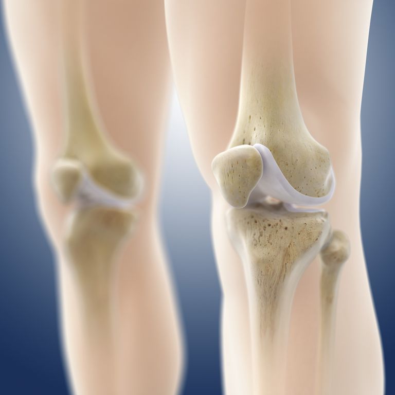 deteriorare cartilajului, leziuni cartilajului, transfer cartilajelor, transfer cartilajului, zona deteriorare, articulația genunchiului