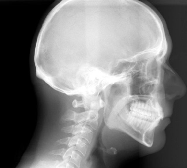 radiografie cefalometrică, cefalometrică este, radiografie cefalometrică este, tratamentului ortodontic, care este, este asemenea