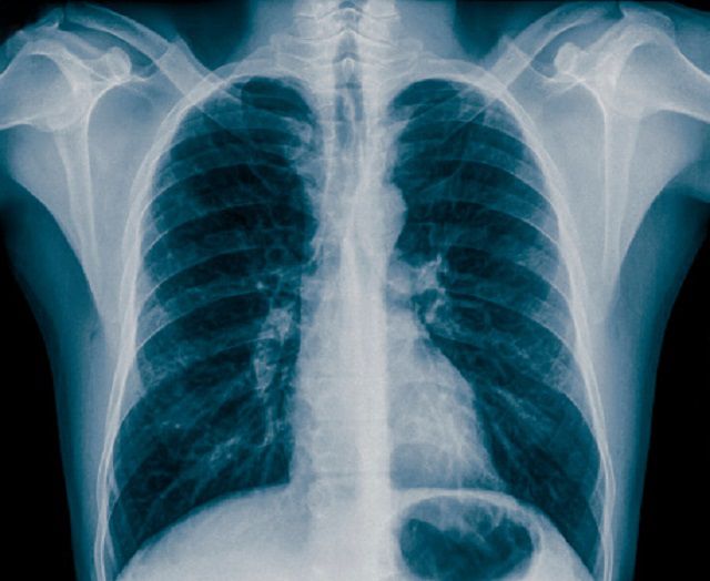 astm bronșic, expunere radiații, astmului bronșic, atunci când, cere pacientului