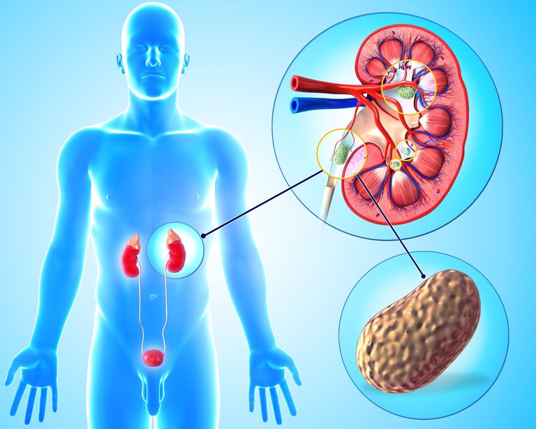 pietre rinichi, calciu urină, ceea poate, pentru preveni, pietrele rinichi