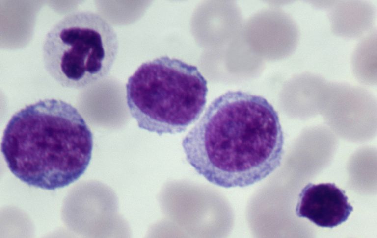 albe sânge, Celulele leucemice, este leucemia, leucemia acută, măduva osoasă, simptomele leucemiei