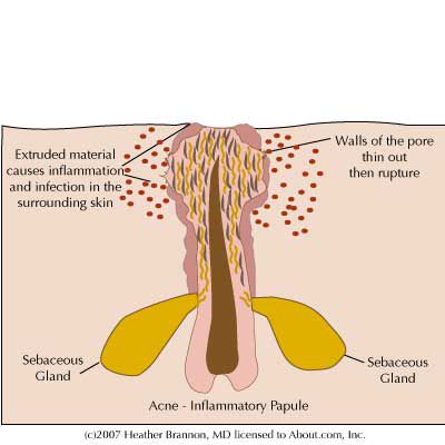 aderența celulelor, aderența celulelor pielii, celulelor pielii, bacteriile acnes, Acestea sunt
