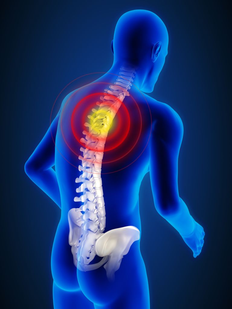 coloanei vertebrale, DISH este, coloanei vertebrale toracice, ligamentului longitudinal, osificarea ligamentului