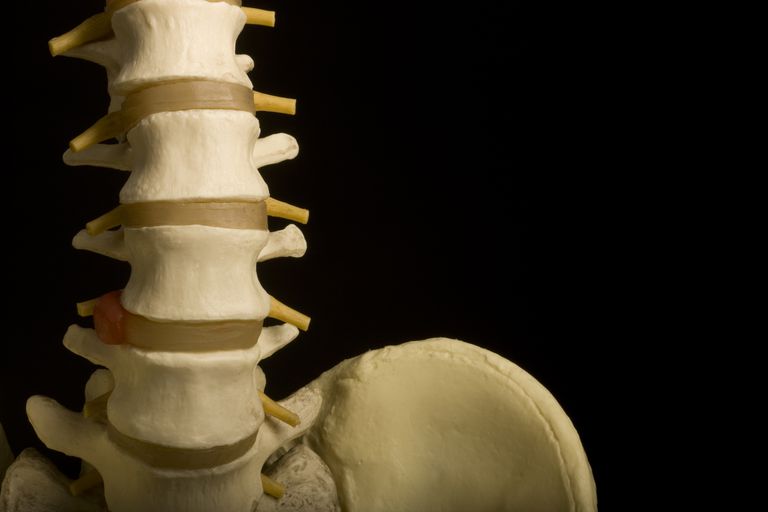 coloanei vertebrale, disc bulging, dureri spate, bulgări disc