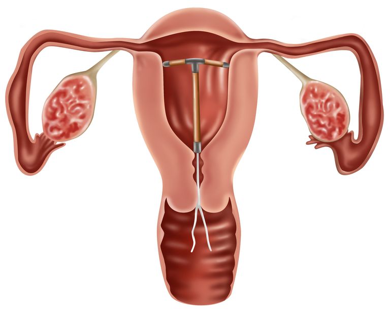 cancerului uterin, Cancerul uterin, cancer uterin, femeile care, uterin este, Este posibil