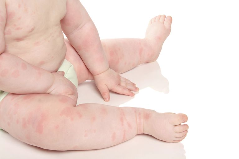 eczema copilului, alergii alimentare, alergiile alimentare, copilului dumneavoastră