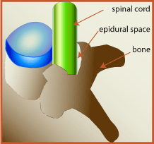 Spațiul epidural, măduva spinării, coloanei vertebrale, Injecții epidurale, acest tratament