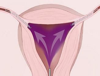 tuburile uterine, colului uterin, dintre femei, după procedura