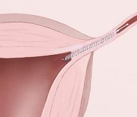 tuburile uterine, colului uterin, dintre femei, după procedura