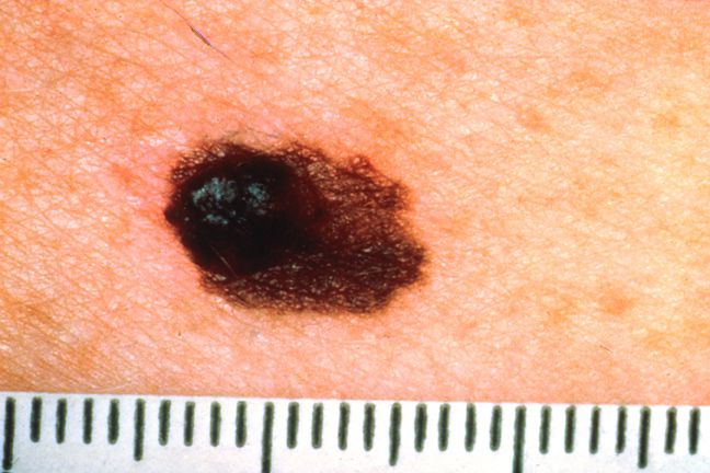 care este, tumoare melanom, cancer piele, Dacă observați