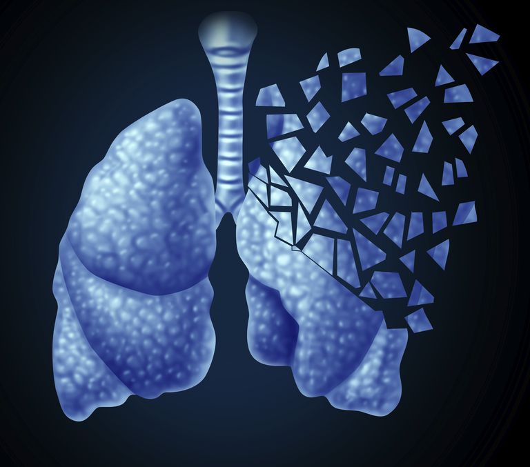 cancer pulmonar, cancerul pulmonar, pulmonar este, cancerului pulmonar, Statele Unite, cancerul pulmonar este