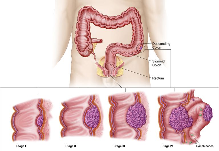 cancerului colon, cancerul colon, Ganglionii limfatici, colon medicul, departe răspândit