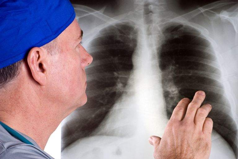 cancer pulmonar, cancerului pulmonar, căile respiratorii, care este, cancerul pulmonar