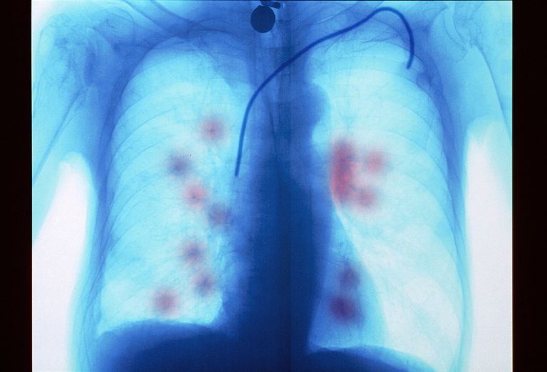 metastazelor pulmonare, cancerul primar, metastaze pulmonare, răspândit plămâni, cancer care, cancer metastaze