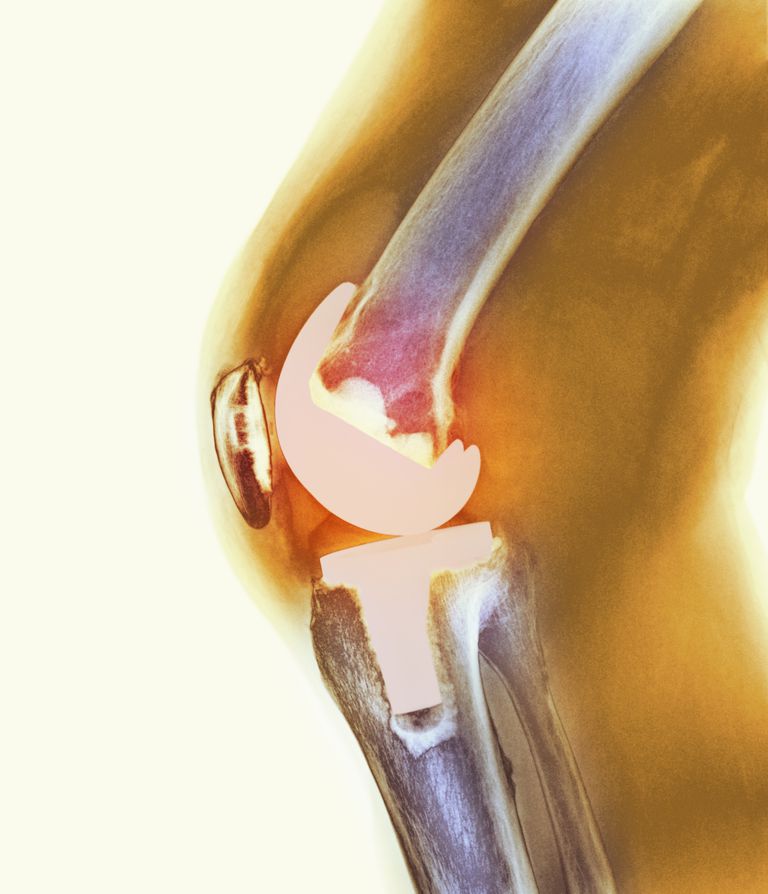 articulației genunchiului, articulația genunchiului, genunchiului este, despre cartilajul, este efectuată