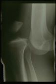 dislocare genunchiului, dislocare genunchiului este, genunchiului este, genunchiului sunt, atunci când, după dislocare