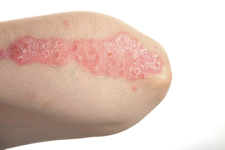 lichen planus, este afecțiune, Fenomenul Koebner, afecta pielea, apare atunci, apare atunci când