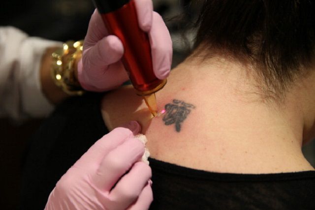 tatuajelor laser, despre îndepărtarea, îndepărtarea tatuajelor, îndepărtarea tatuajelor laser, multe despre, despre îndepărtarea tatuajelor