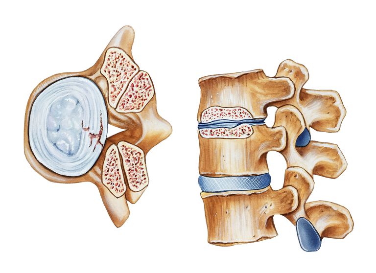 canalului spinal, care este, coloanei vertebrale, ligamentum flavum, locașului lateral