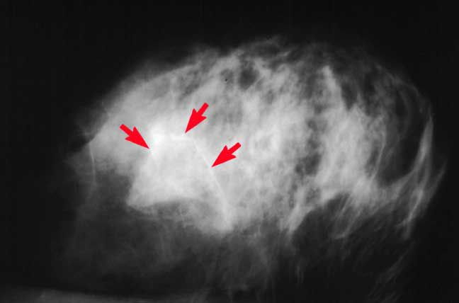 țesut dens, țesutul mamar, imagine mamografică, medicul dumneavoastră, Această mamografie