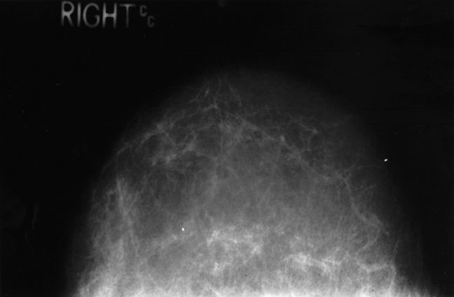 țesut dens, țesutul mamar, imagine mamografică, medicul dumneavoastră, Această mamografie
