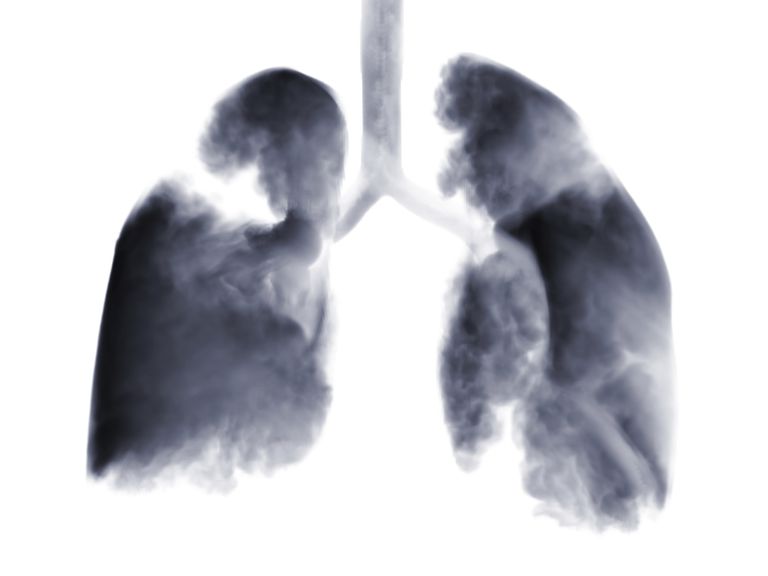 celule mici, pulmonar celule, cancer pulmonar, pulmonar celule mici, celule mici este