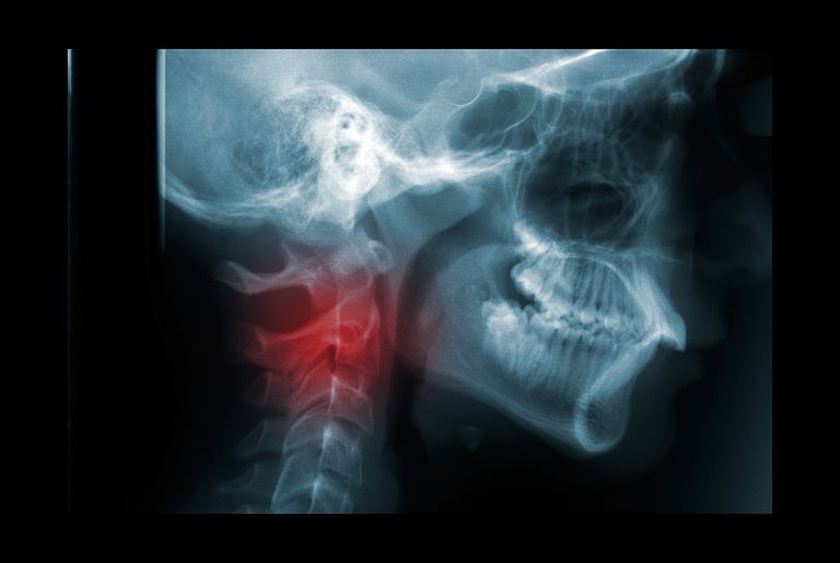 coloanei vertebrale, nivelul gâtului, atunci când, coloanei vertebrale cervicale