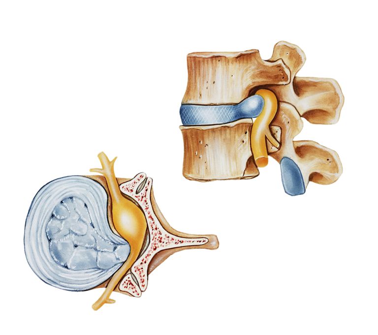 coloanei vertebrale, canalul spinal, eveniment traumatic, intervenție chirurgicală, este adesea