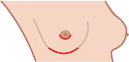 mastectomie care, care protejează, care protejează mamelonul, mastectomie care protejează, nivelul mamelonului