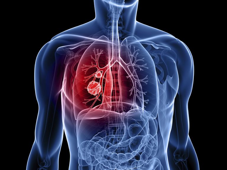 cancer pulmonar, celule mici, pulmonar celule, cancerului pulmonar, pulmonar celule mici