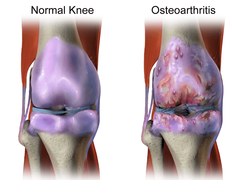 trebuie știți, Osteoartrita este, cartilajului articular, coloanei vertebrale