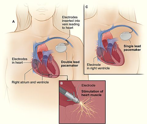 stimulator cardiac, intervenție chirurgicală, cardiac este, chirurgia inimii