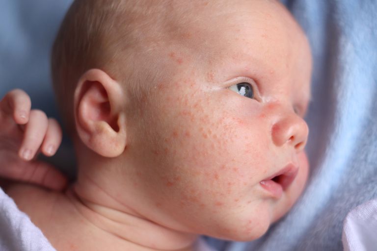 acnee infantilă, acnee pentru, copilului dumneavoastră, acneea copilului