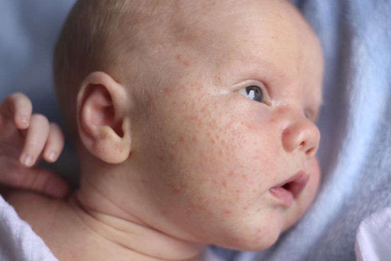 acneea copiilor, acneea nou-născutului, după naștere, nou-născutul acnee, Acest lucru, acnee pentru
