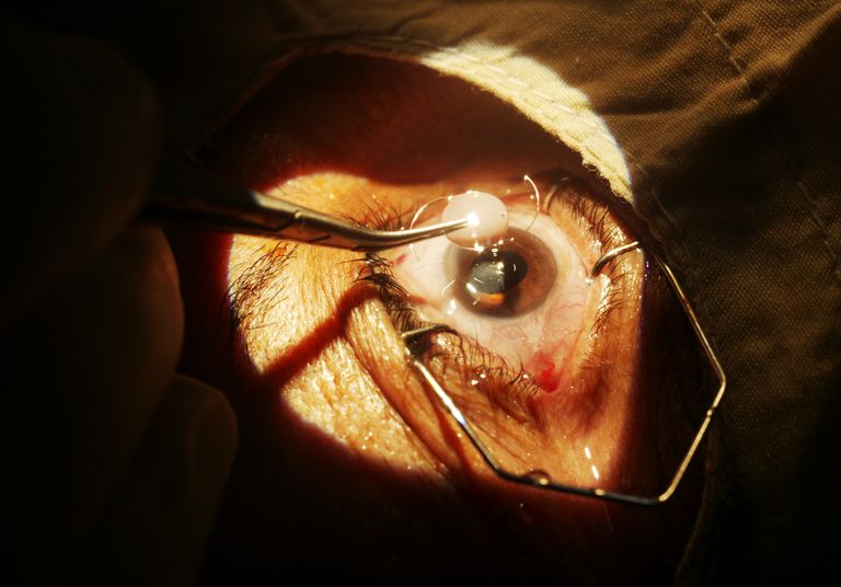 anestezie locală, astfel încât, chirurgie cataractei, eliminat cataracta, groși grei