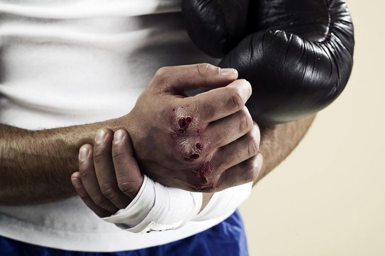 unui boxer, încheietura mâinii, fractura unui, fractura unui boxer