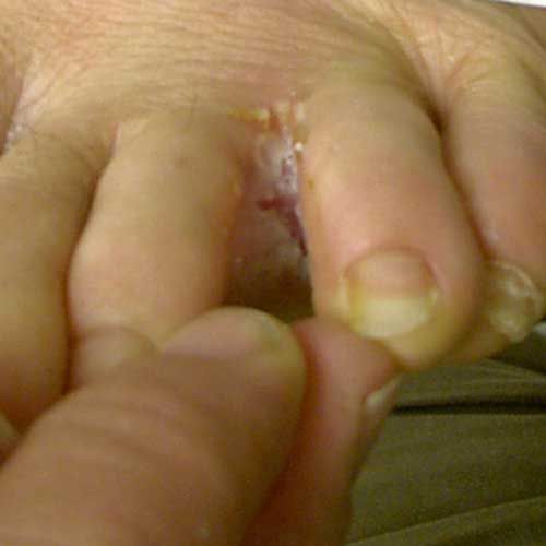 este infecție, erupție cutanată, herpes simplex, între degete, acesta este