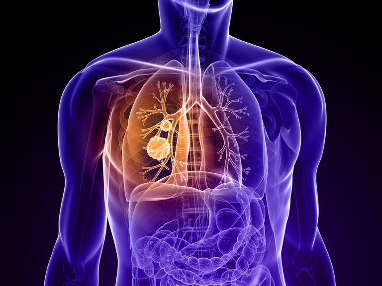 cancer pulmonar, masă pulmonară, medicul dumneavoastră, masa pulmonară, nodul pulmonar