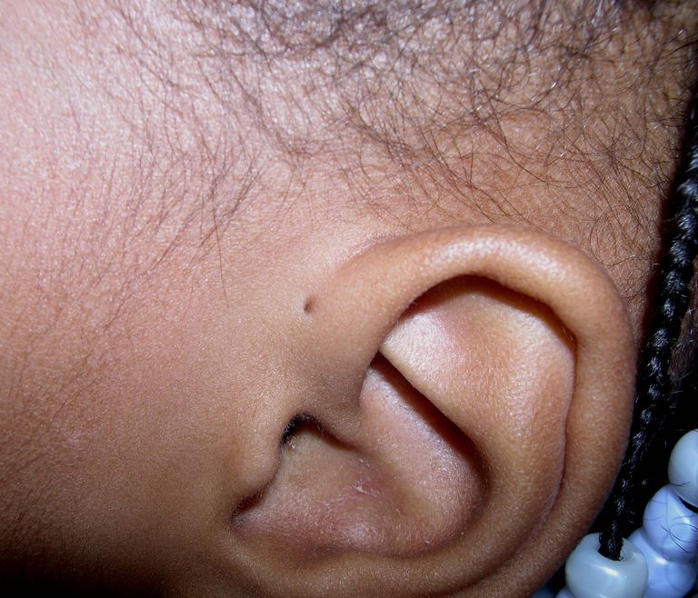 groapă preauriculară, groapă poreuriculară, Acest lucru, alte anomalii, alte anomalii urechii, ambele urechi